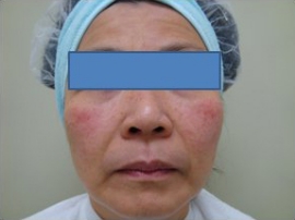 Sciton Laser Resurfacing