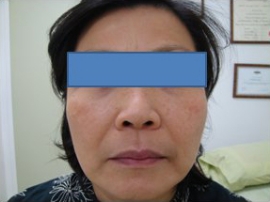 Sciton Laser Resurfacing