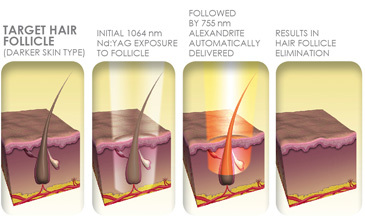 elite multiplex laser hair removal