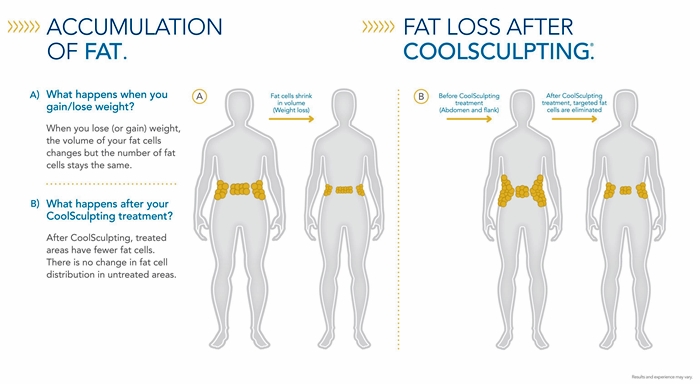 CoolSculpting &amp; Double Chin Fat Removal Treatment in 